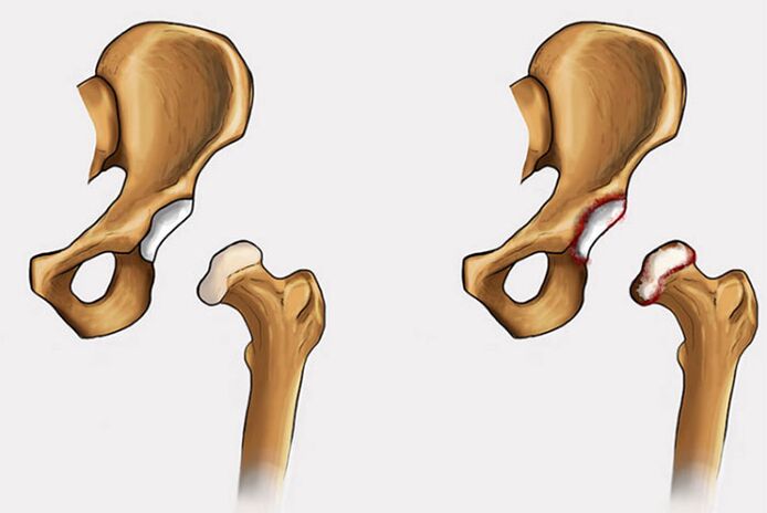 degenerative Veränderungen und Schmerzen im Hüftgelenk