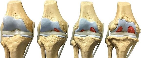 Deforming Knie -Arthrose