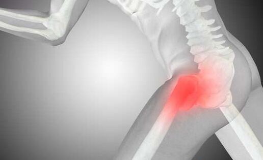 Hüftgelenk -Osteoarthritis