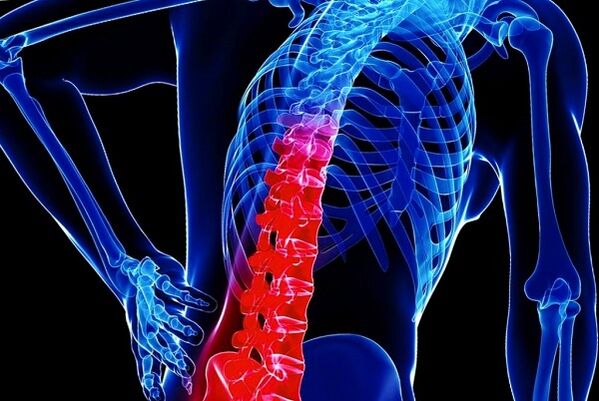Die Gründe für die Entwicklung der Thoraxosteochondrose