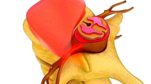 Osteochondrose der Thoraxsäule Die Essenz der Krankheit