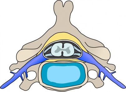 Protabian in der Wirbel mit zervikaler Osteochondrose